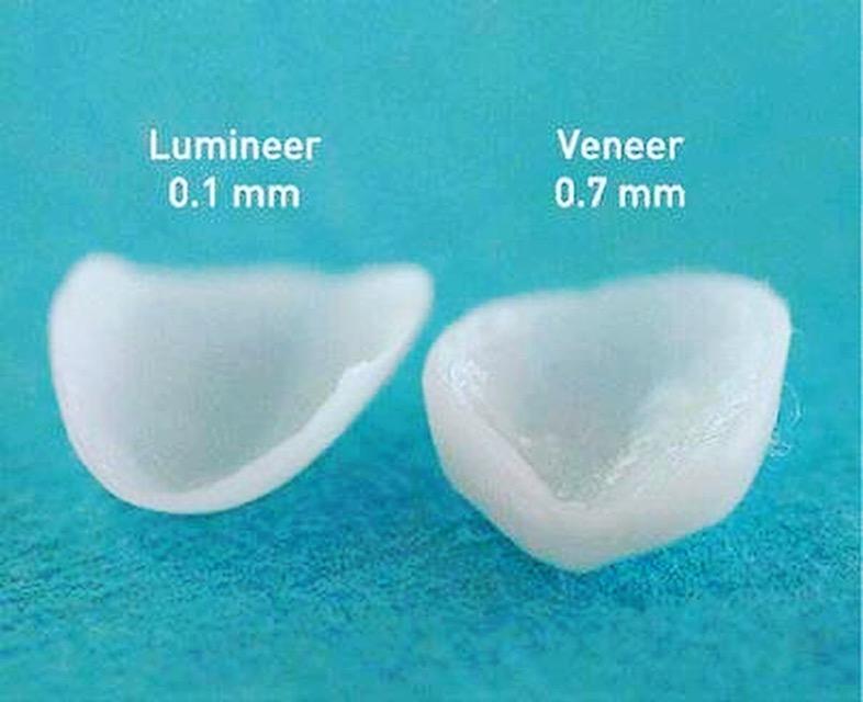 Veneers & Lumineers